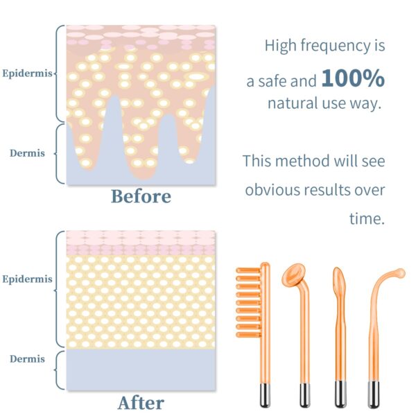 High-Frequency Skin Therapy Device – Acne Care & Skin Rejuvenation Tool - Image 3